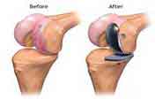 knee replacement