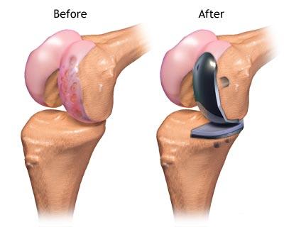 joint replacement surgeon